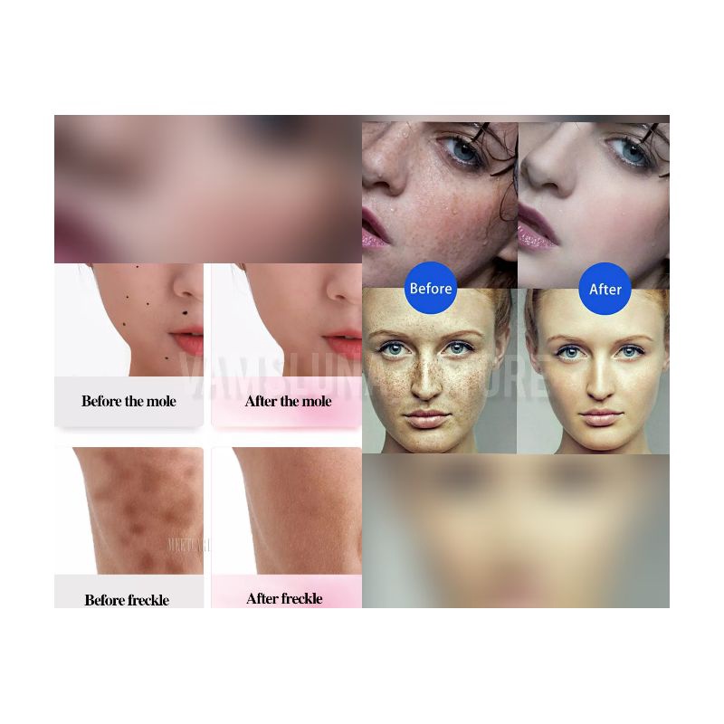 Mini Freckle Pen / Portable Couter Penghilang Spots / Moles / Fleshy Nevus / Tato /TATTO Tahi Lalat // Soft cauter laser penghilang flek tai lalat kutil tatto bintik hitam melasma milia plasma pen