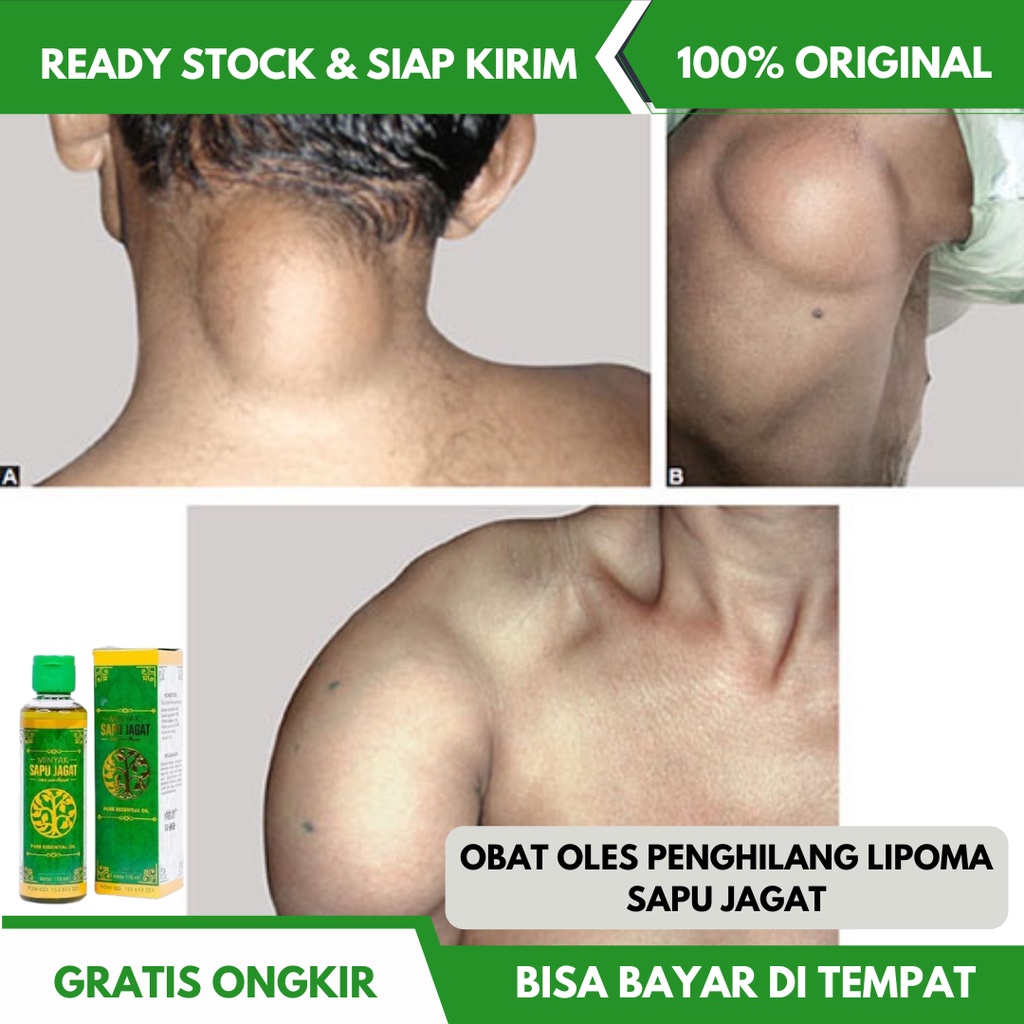 Obat Penghilang Lipoma, Obat Benjolan Lemak, Benjolan Lipoma, Uci Uci, Obat Kelenjar Lipoma, Penghan