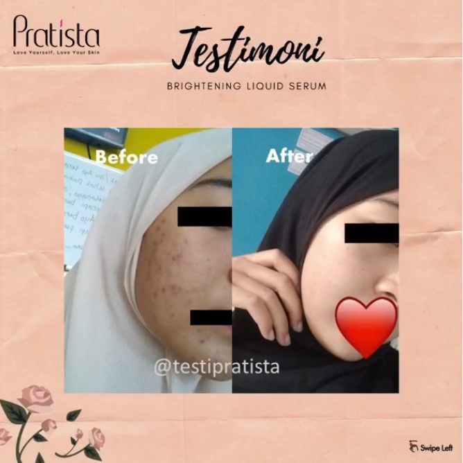 Serum Penghilang Flek Hitam Bekas Jerawat di Wajah - Brightening Liquid Serum Pratista