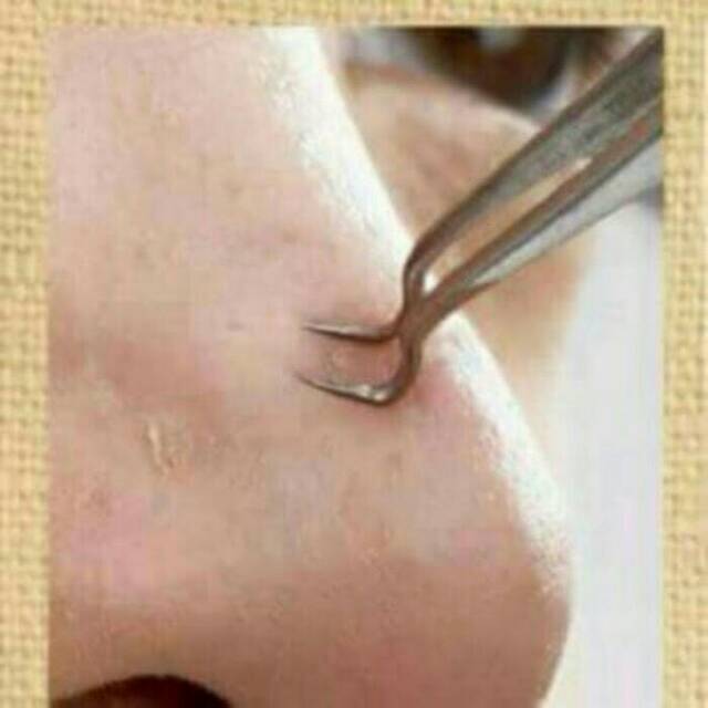 PINSET JEPIT PENCABUT KOMEDO JERAWAT / BLACKHEAD ACNE TWEEZER