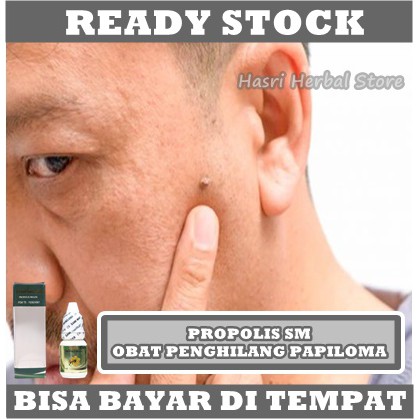 Obat Penghilang Papiloma - Obat Tradisional Papiloma - Solusi Untuk Menghilangkan Papiloma - Obat Untuk Kutil Di Leher - Penghilang Kutil - Obat Pengempis Daging Jadi - Menghilangkan Daging Jadi - Obat Herbal Kutil Di Wajah Dengan Herbal Propolis SM