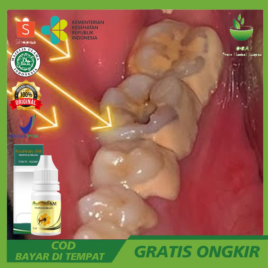 Obat Perontok Karang Gigi Pembersih Karang Gigi Penghancur Karang Gigi Menghilangkan Karang Gigi Mem
