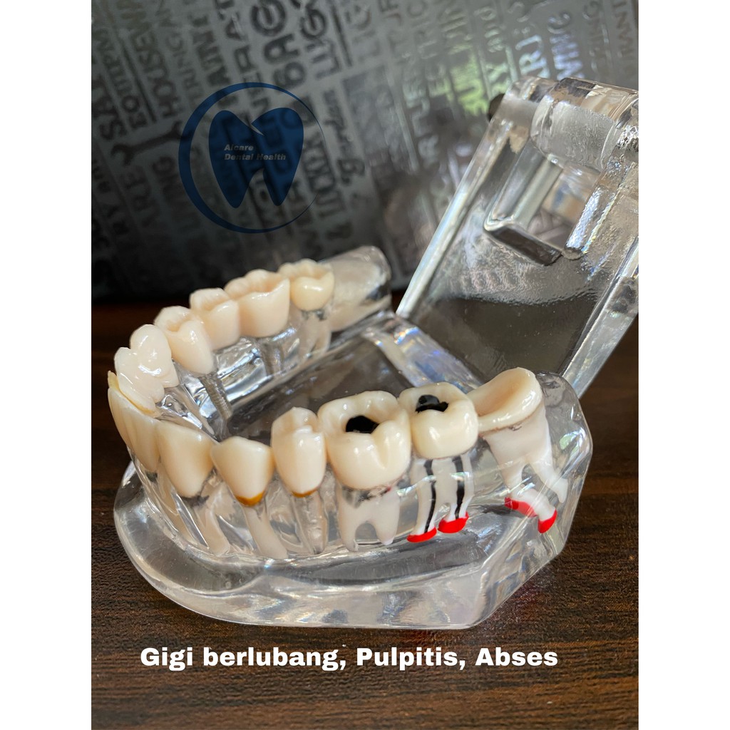 Model peraga Gigi Profesional TERBARU dengan Kondisi Penyakit lengkap MUDAH dilepas dan dipasang