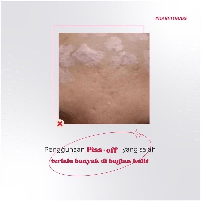 PRETTYWELL PISS-OFF BLEMISH SPOT CREAM (ACNE SPOT)