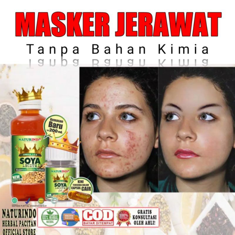 Obat dan Masker Jerawat paling Ampuh Bekas Bopeng Herbal Alami Naturindo OSL SOYA LECITHIN BPOM