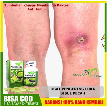 Obat Pengering Luka Bisul Pecah Herbal Kapsul Bisul Bernanah Berdarah Di Kaki Pantat Kepala Shopee Indonesia