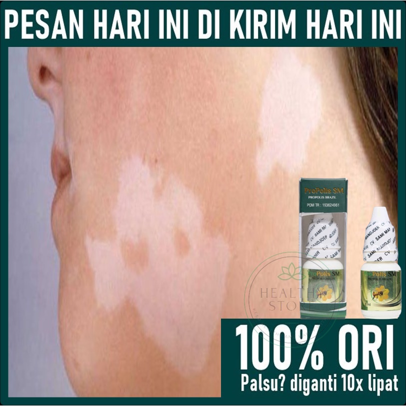 Obat Panu di Wajah - Obat Panu di Punggung / di Leher - Obat Oles Panu - Obat Panu Cair - Obat Jamur