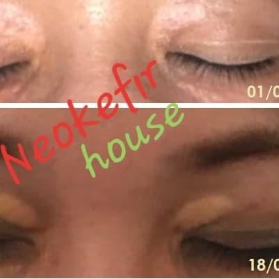 Diskon Besar2an  Xanthelasma Cream 10gr Promo.,.,