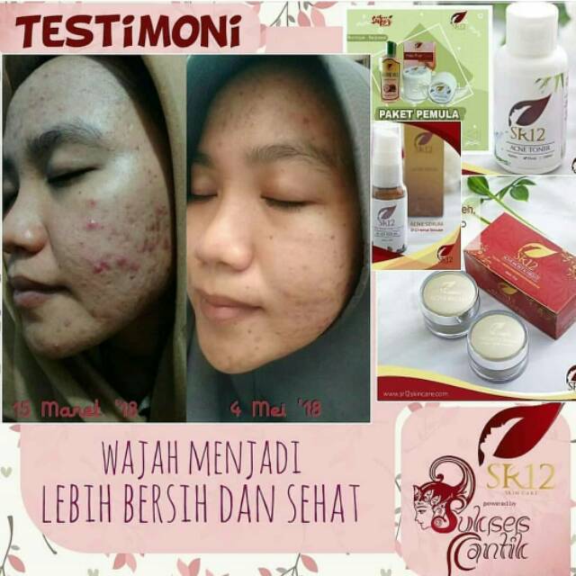 Acne Toner SR12 Toner Wajah Kulit Berjerawat Toner Jerawat Pembersih Perawatan Wajah Untuk Jerawat Beruntusan Acne Toner Face Toner Acne Care Toner