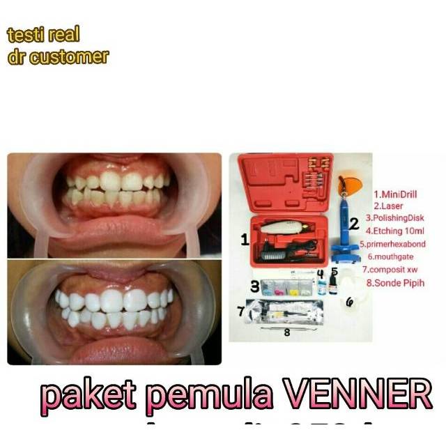 PAKET VENEER GIGI KOMPLIT LANGSUNG PAKAI
