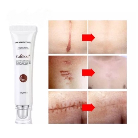 Caidiau Acne Cream - BREYLEE Scar Removal Penghilang Noda Bekas Jerawat, Luka &amp; Stretch Mark