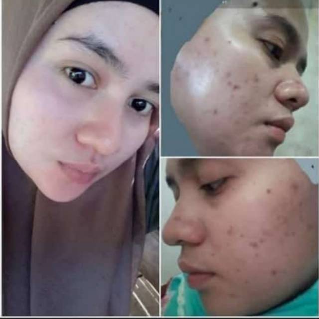 Sabun klinskin bpom terbaru