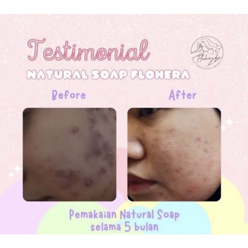 [READY] ✨Flohera Natural Soap Sabun Perontok Daki &amp; Pencerah Badan
