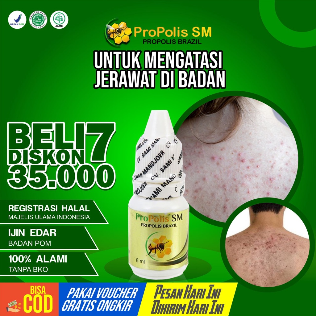 OBAT JERAWAT PUNGGUNG JERAWAT DIBADAN PROPOLIS SM