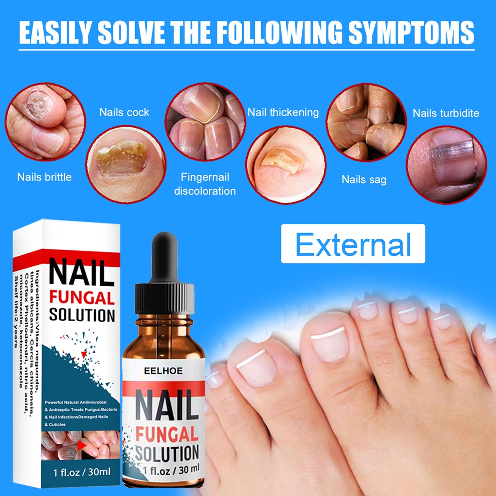 Sumifun Nail Repair Perawatan Krim Jamur Kuku Nail Treatment Nail Fungus Obat Kuku Jamur Perawatan Kuku Rusak Repair -30ml