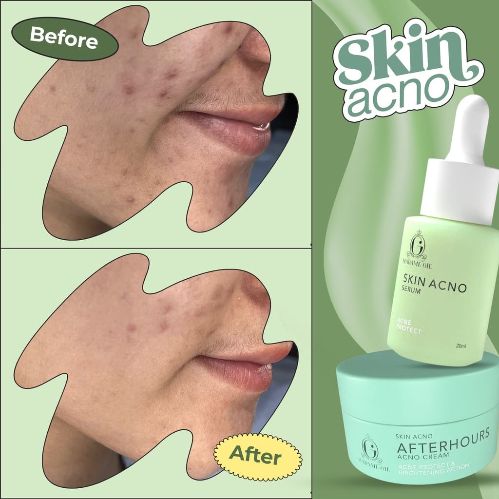 Skin Acno Afterhours Cream 5% Niacinamide - KRIM WAJAH