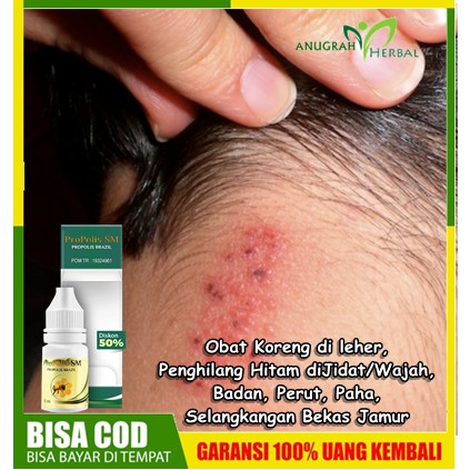 Obat Koreng di leher, Penghilang Hitam diJidat/Wajah, Badan, Perut, Paha, Pembersih Selangkangan Bek