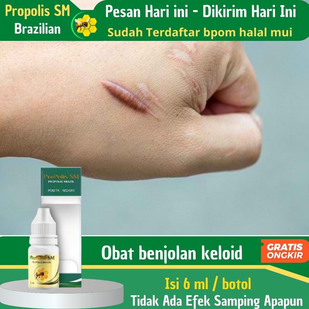 Jual Obat Oles Benjolan Keloid Dan Lipoma Penghancur Benjolan Lipoma