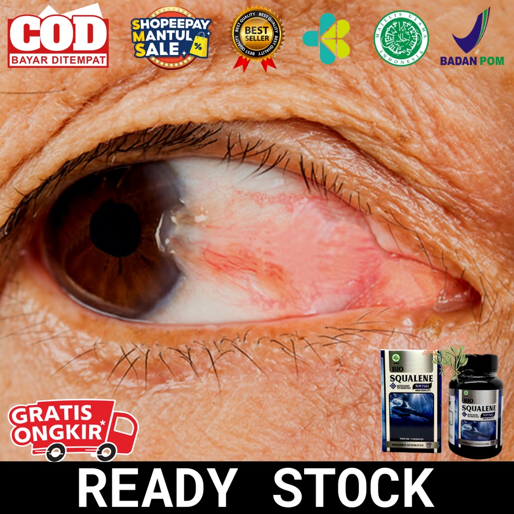 Obat Mata Pterigium, Obat Herbal Mata Pterigium, Obat Mata Pterygium, Obat Mata Berlemak, Obat Mata 