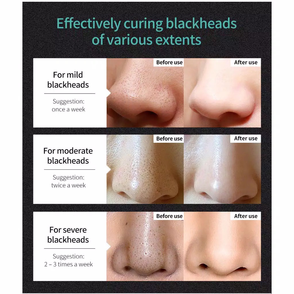 Lanbena Blackhead Remover Mask Peel Off Mask Acne Treatment Remover Nose Black