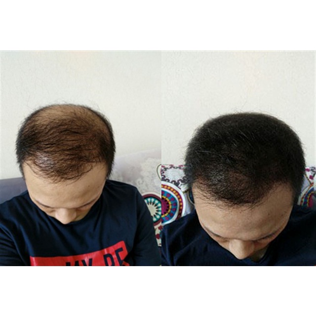 Folihair Shampoo dan Tonic Obat Penumbuh Rambut Botak Serum Rambut Shampo Penumbuh Rambut