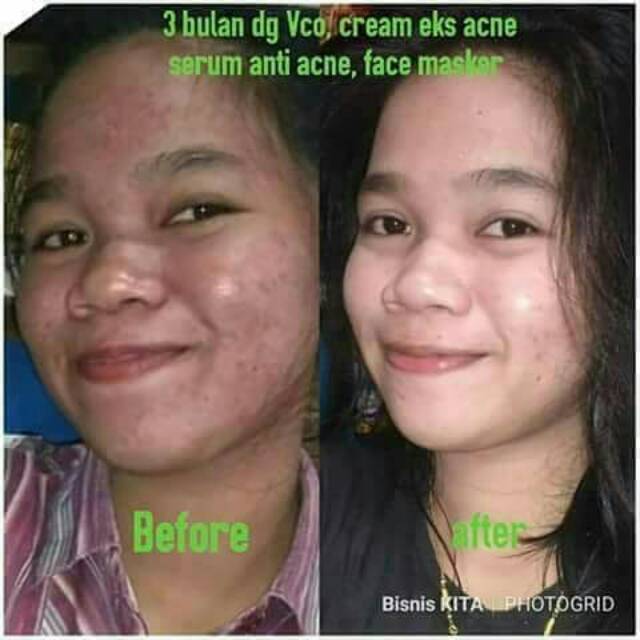 Serum acne