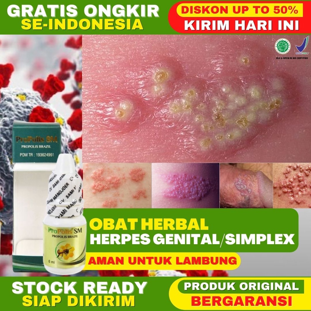 Obat Herbal Herpes Genital Herpes Genital Pada Wanita Herpes Genital Pria Herpes Kelamin Luka Melepu