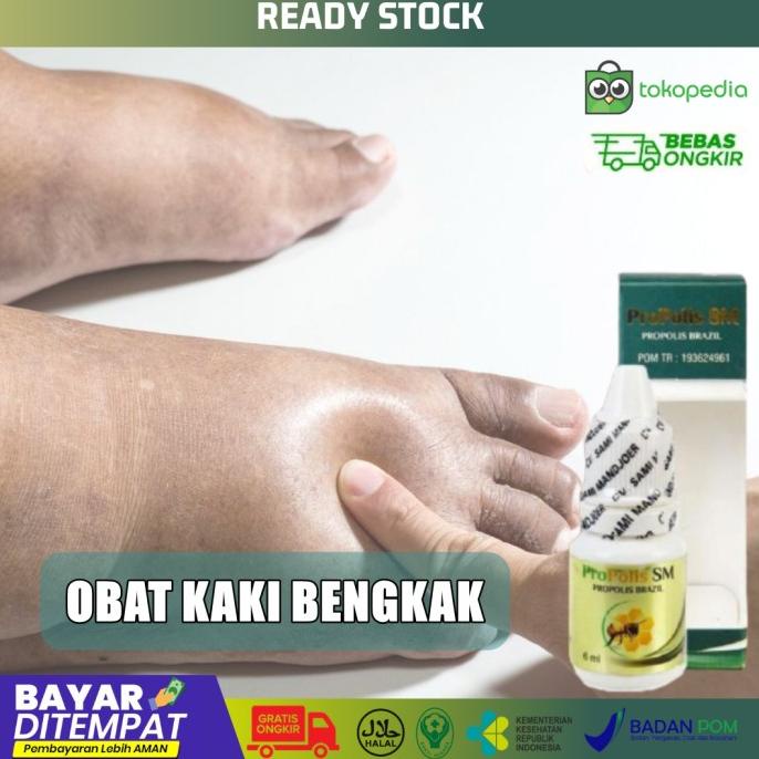 Obat Kaki Bengkak Herbal, Obat Pergelangan Kaki Bengkak - Propolis SM