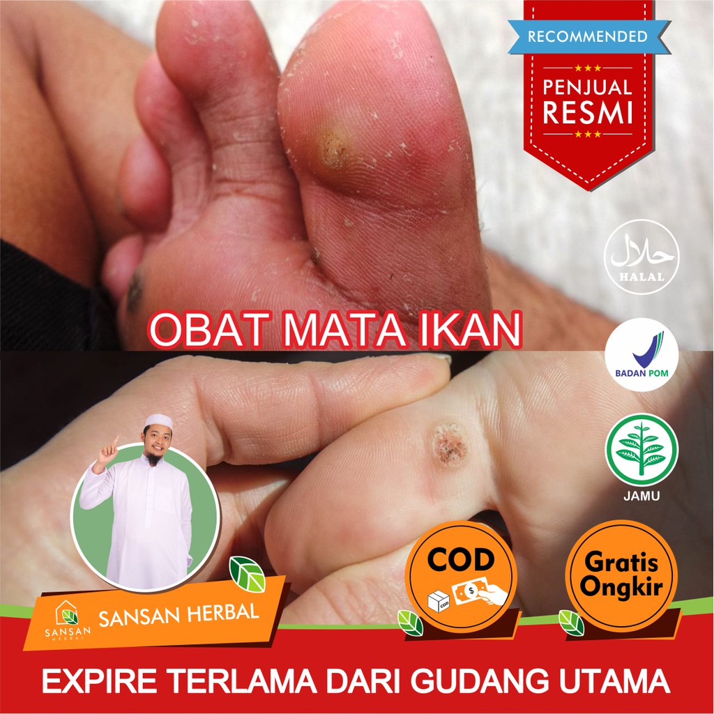 Jual Obat Herbal Mata Ikan Dan Kutil 100 Asli Original Kapalan Mata