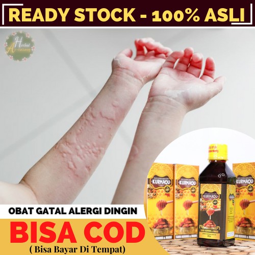 obat alergi gatal kulit cuaca dingin,obat alergi gatal anak,obat biduran anak anak | Kurmaqu asli