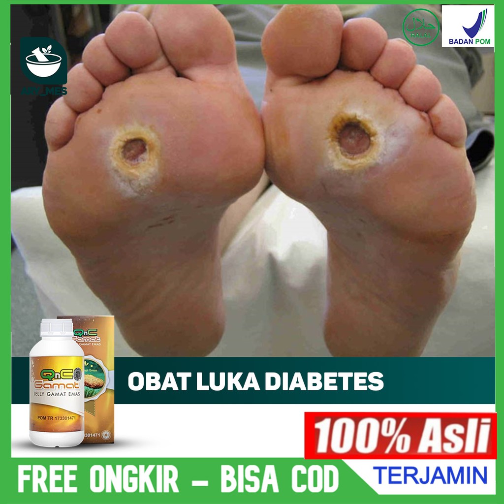 Obat Oles Luka Diabetes - Luka Borok- Luka Gangren, Luka Diabetes Basah QnC Jelly Gamat Emas ASLI