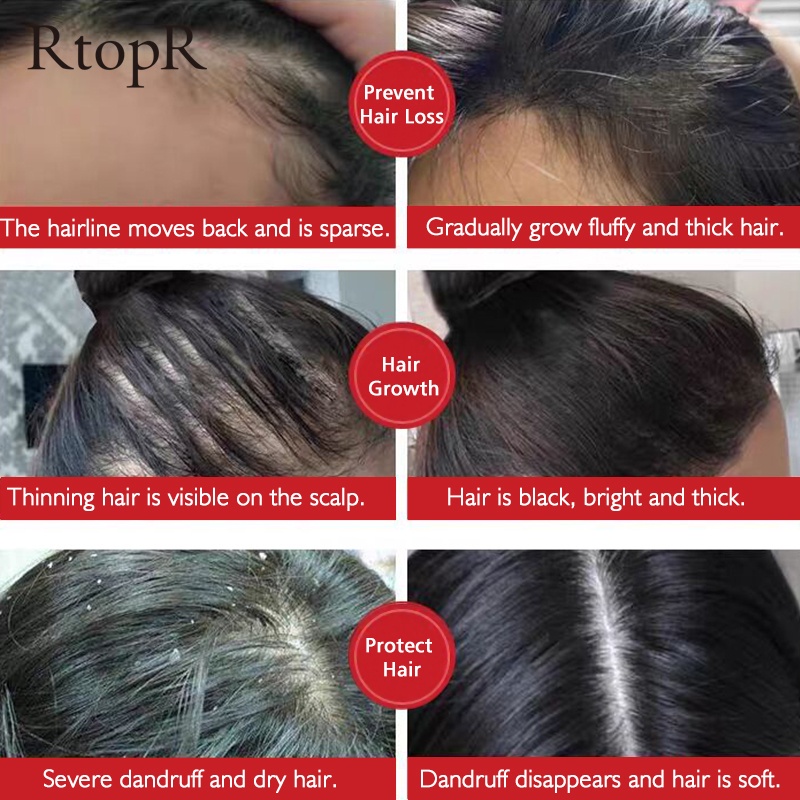 [100% Asli + Ampuh] RtopR Minyak Rambut Anti Rontok Botak Perawatan Pertumbuhan Rambut Cepat Tebal 20ml