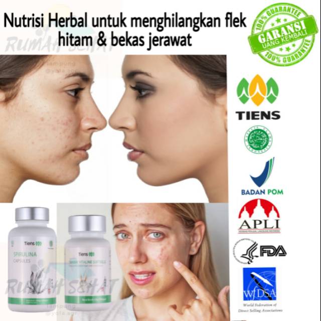 

Nutrisi kulit herbal untuk flek hitam dan bekas jerawat
