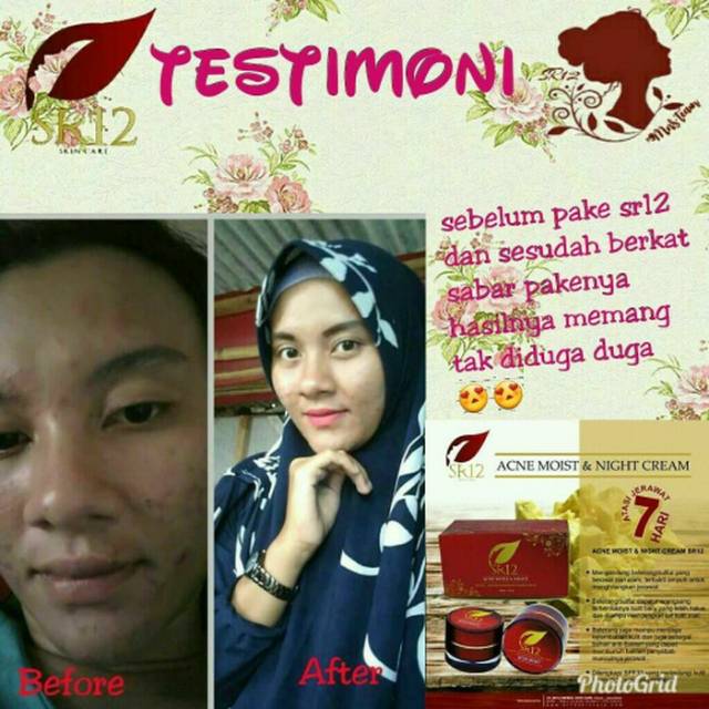 Acne Moist and Night krim siang dan malam SR12 BPOM ORIGINAL