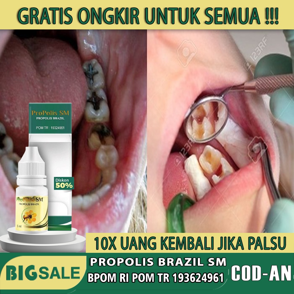 Obat Sakit Gigi Berlubang / perontok gigi berlubang - Obat penghancur gigi berlubang - Perontok akar