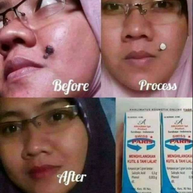 Obat Kutil Tahilalat Ampuh