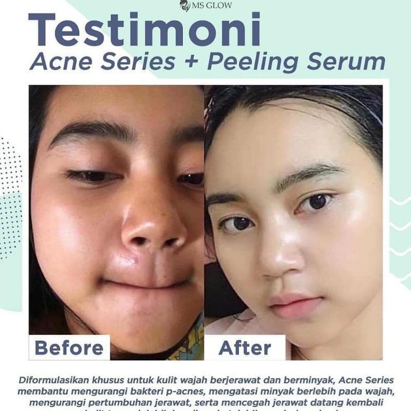 Peeling Serum Ms Glow / Pelling / Serum / Mencerahkan wajah / menghilangkan bekas jerawat / Original