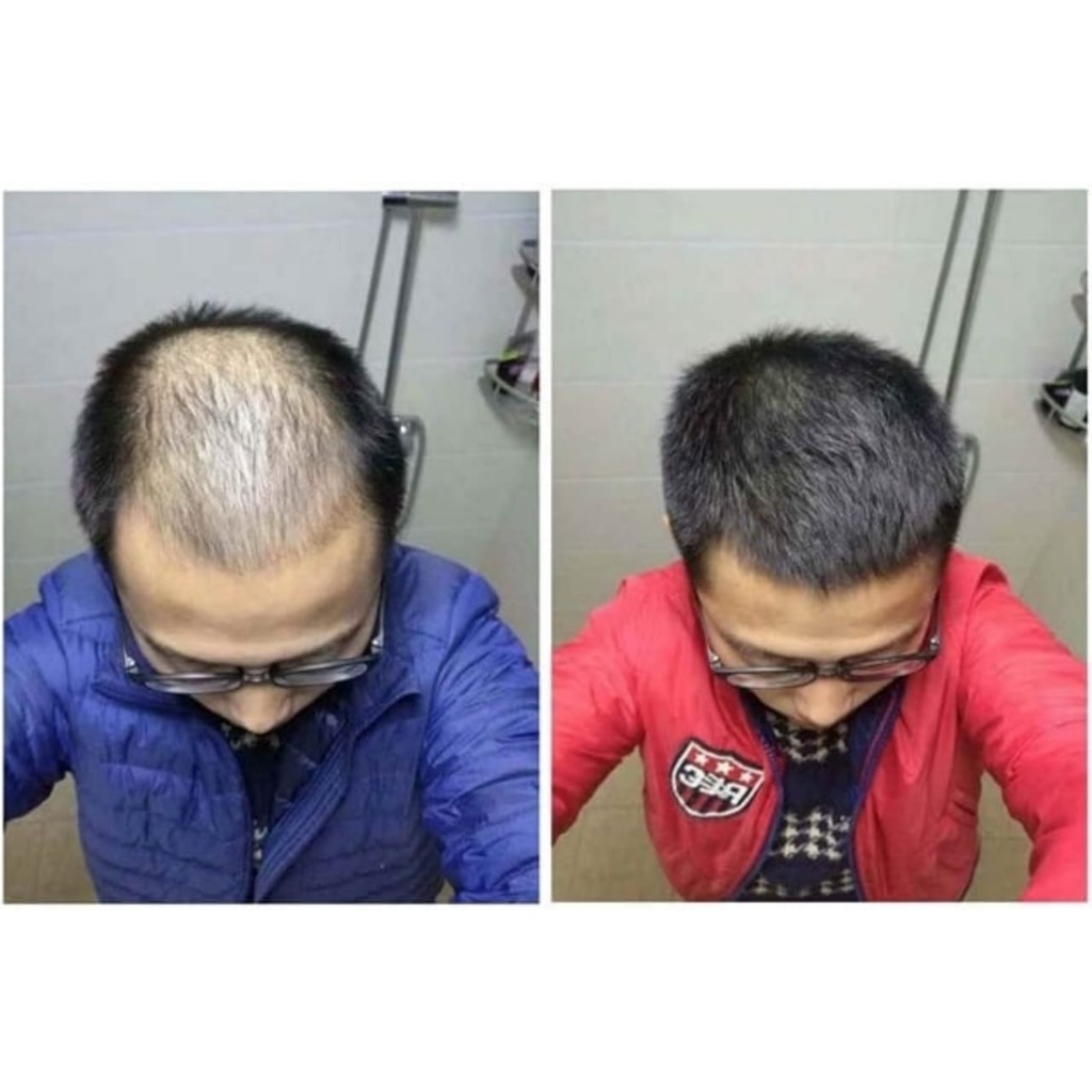 Folihair Shampoo dan Tonic Obat Penumbuh Rambut Botak Serum Rambut Shampo Penumbuh Rambut