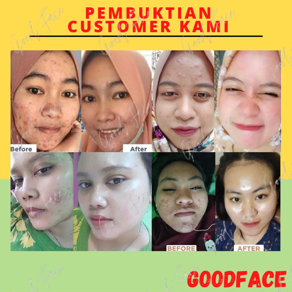 SERUM UNTUK WAJAH BERJERAWAT-Hanasui Serum Anti Acne Original BPOM - Acne Serum Hanasui Jaya Mandiri