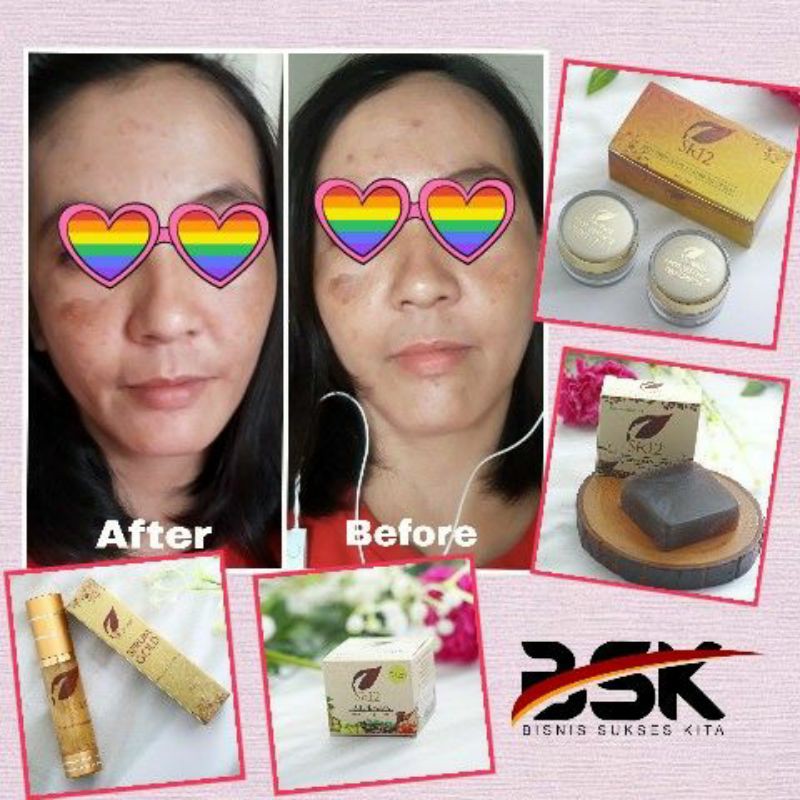 TUMPAS BEKAS JERAWAT , FLEK HITAM &amp; NODA WAJAH ..!! SPOT ESSENCE DAY &amp; NIGHT CREAM SR12 STANDAR BPOM