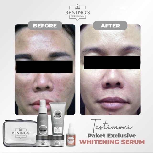 BENING'S PAKET EXCLUSIVE | MENGATASI MASALAH FLEK, MELASMA &amp; MENCERAHKAN