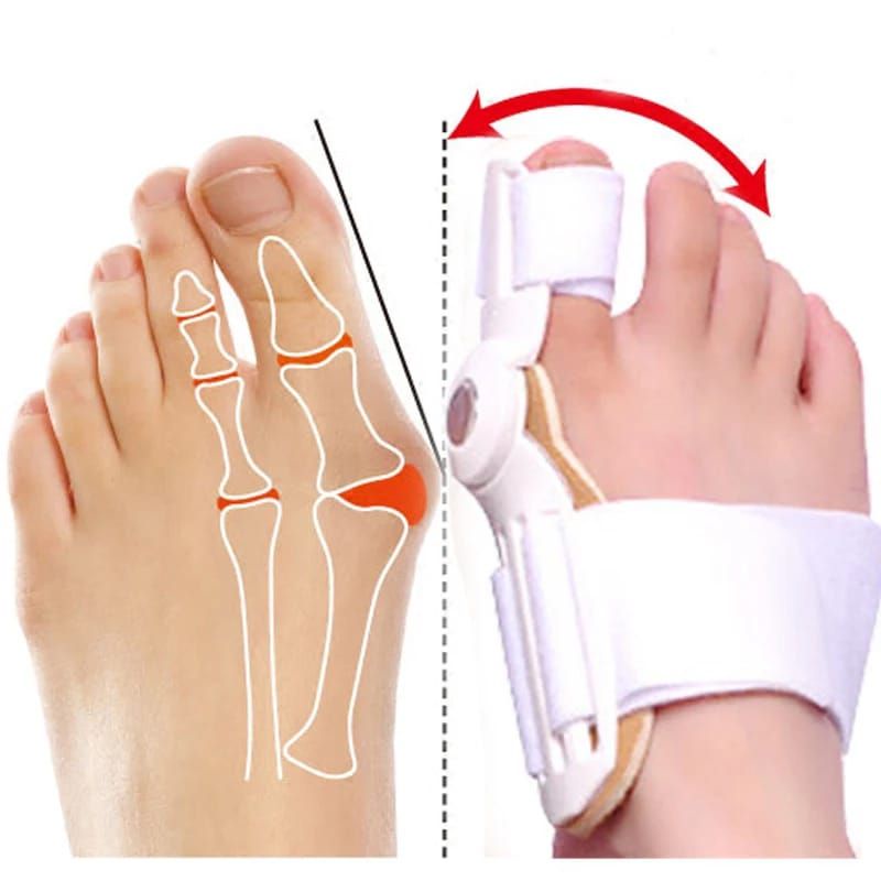 BUNION CORRECTOR SPLINT ALAT TERAPI KAKI BUNION HALLUX VALGUS TERAPI JARI KAKI BENGKOK INSOLE SEPATU