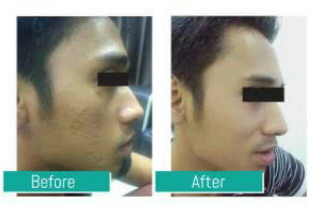 Azanis Scar Serum Health Beauty Skin Bath Body On Carousell