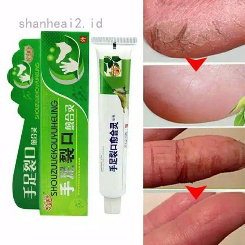 OBAT TELAPAK KAKI PECAH-PECAH KAPALAN DAN KUTU AIR