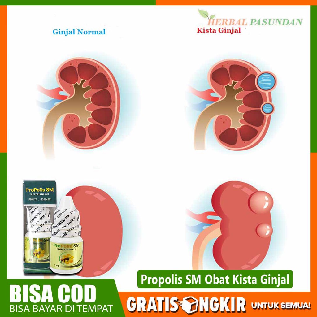 Obat kista ginjal, obat kista ovarium, kista rahim, kista payudara, kista evidermoid Propolis Sm