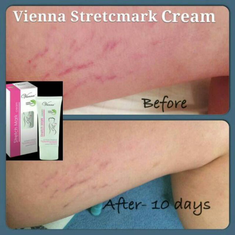 PENGHILANG STRECHMARK AMPUH PERMANEN BPOM 3 STRETCH MARK CREAM KRIM OBAT SALEP ORIGINAL