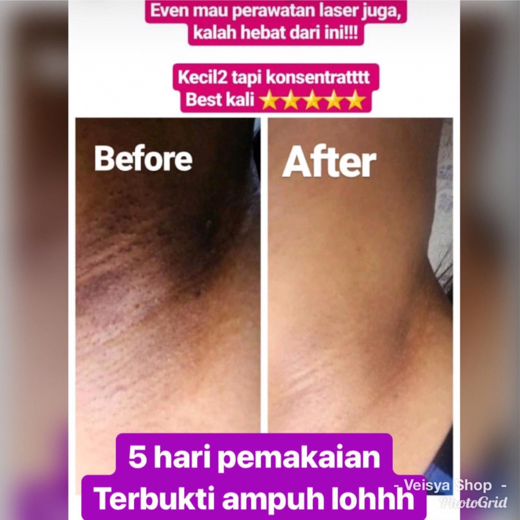 SHINE STAR - [BISA COD] Pemutih Ketiak BABY WHITENING Cream Pemutih Shinkurim Ori - Ketiak Putih Bersih dalam Seminggu Ampuh - Pemutih Leher dan Area Kewanitaan - 1 Pcs