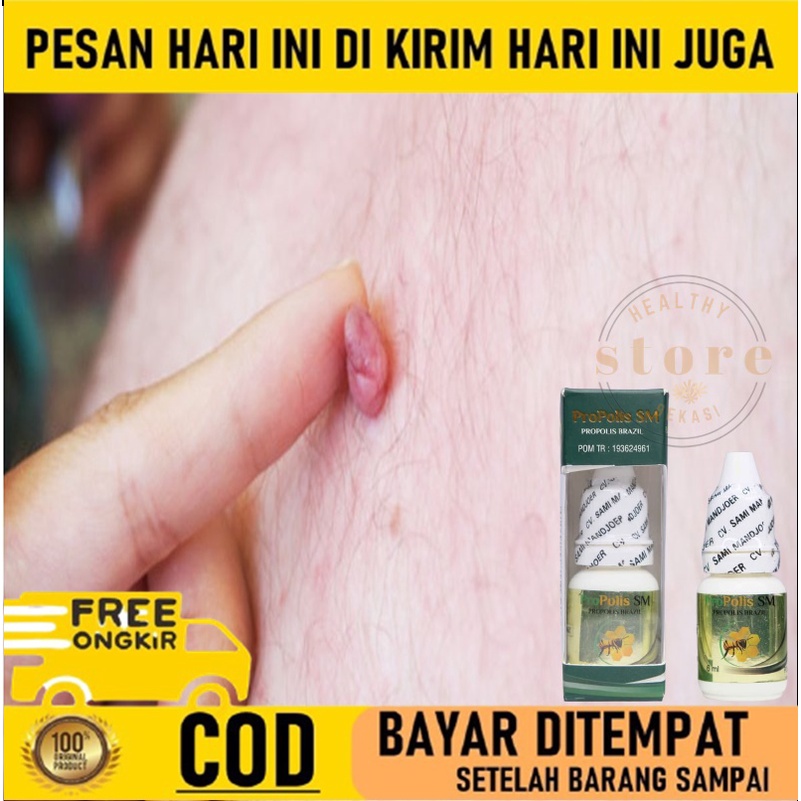 Penghilang daging tumbuh / Skintag - Obat Penghilang kutil - Obat Papiloma - Obat Papiloma leher - P