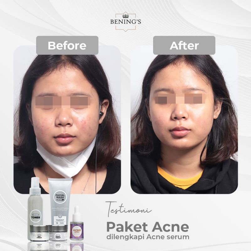 BENING SKINCARE DOCTOR OKY PRATAMA ACNE JERAWAT | BENING CLINIC | BENING SKINCARE DR OKY PRATAMA