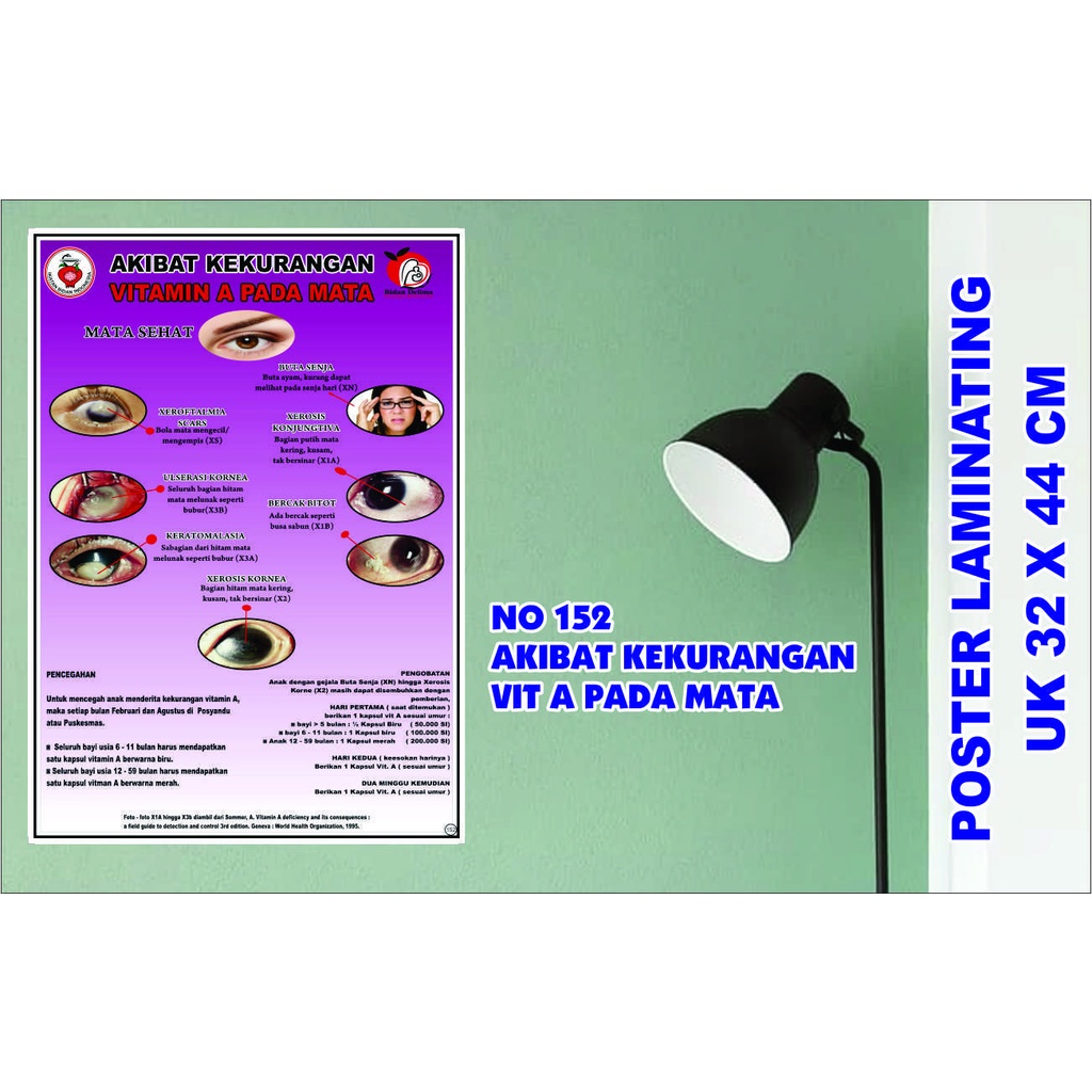 POSTER KESEHATAN NO. 152 AKIBAT KEKURANGAN VIT A PADA MATA